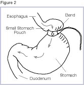 Illustration of a stomach with an adjustable gastric band