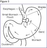 Illustration of Vertical Banded Gastroplasty (VBG)