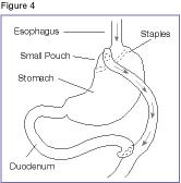 Illustration of the Roux-en-Y gastric bypass (RGB)