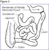 Illustration of Biliopancreatic diversion (BPD)