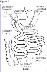 Illustration of Biliopancreatic diversion (BPD) that includes a duodenal switch